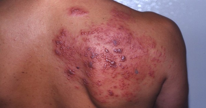 Fever blister: MedlinePlus Medical Encyclopedia Image
